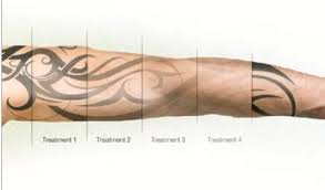 FDA Tattoo removal no simple process  CBS News